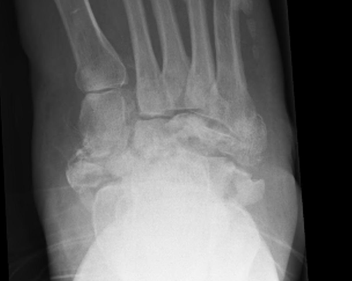 Charcot Foot Stage 3 Consolidation
